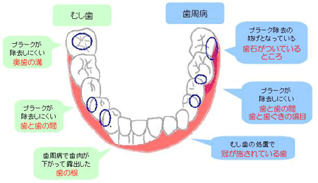 磨き残しの多い部位